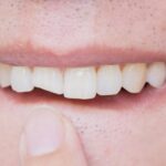 What to Do If You Crack a Tooth